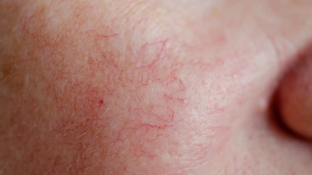 Image of a human face with spider veins problem