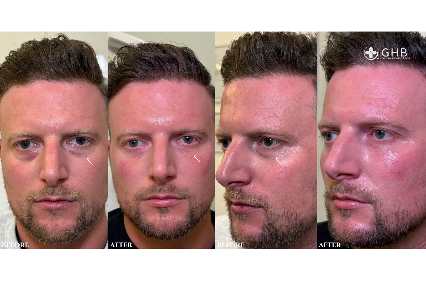 Image of a male patient before and after tear trough filler transformation